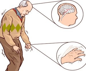 malattia-di-parkinson