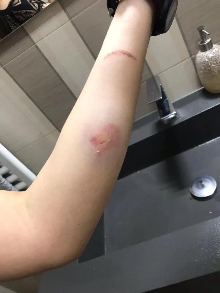 ospedale-frattamaggiore-infermiera-morsa-braccio