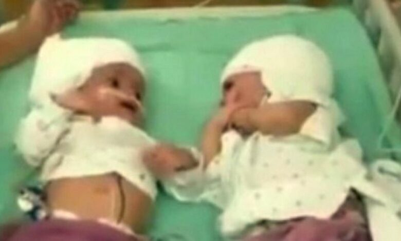 gemelle-siamesi-israele-raro-intervento